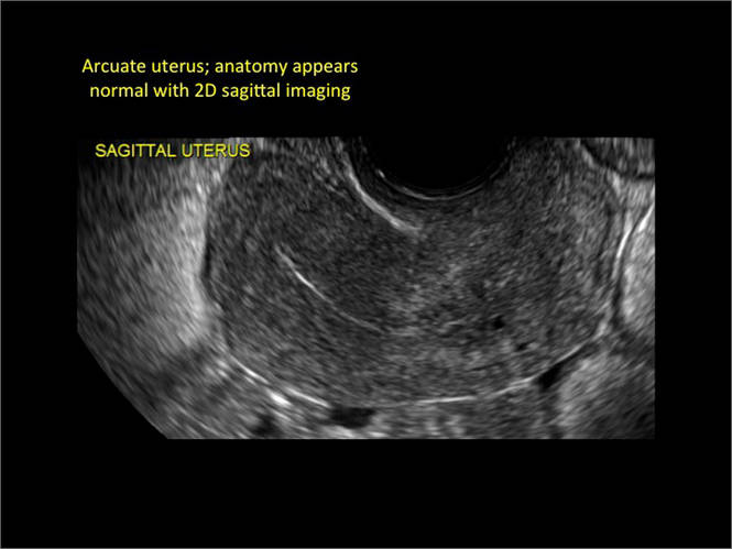 Congenital Uterine Anomalies A Resource Of Diagnostic Images Part