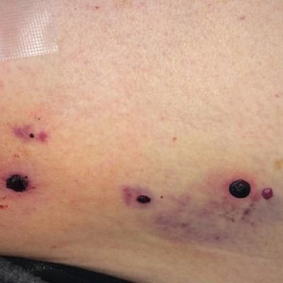 Enoxaparin Induced Hemorrhagic Bullae At Sites Of Trauma And