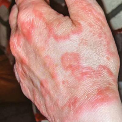 Erythematous Plaques On The Dorsal Aspect Of The Hand Mdedge Dermatology