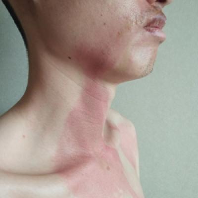 Burning Skin Patches On The Face Neck And Chest Mdedge Dermatology