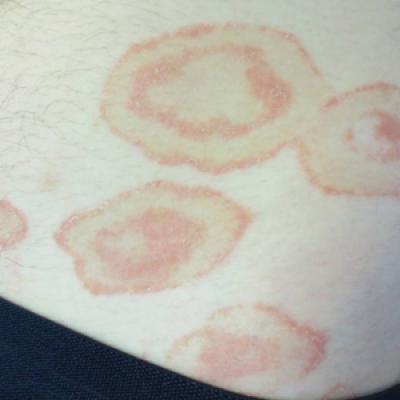 Scaly Annular And Concentric Plaques MDedge Dermatology