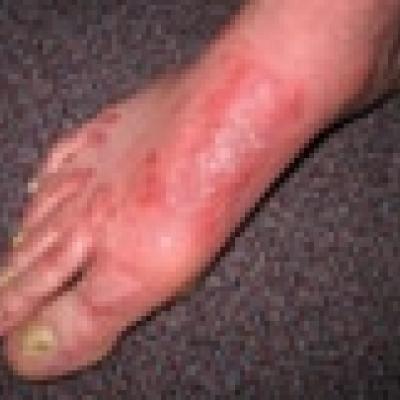 Interstitial Granulomatous Dermatitis Associated With Chronic