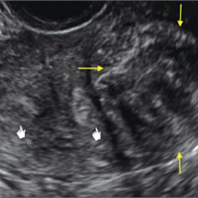 Congenital Uterine Anomalies A Resource Of Diagnostic Images Part 1