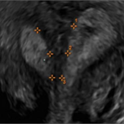 Congenital Uterine Anomalies A Resource Of Diagnostic Images Part