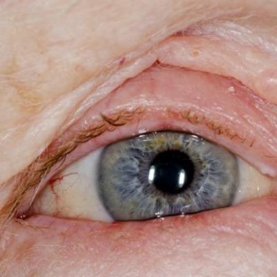 Red Swollen Eyelids Atopic Dermatitis Challenge Center