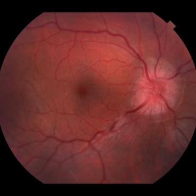 Decreased Visual Acuity And Paresthesia Multiple Sclerosis Challenge