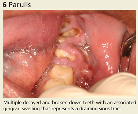 Parulis image