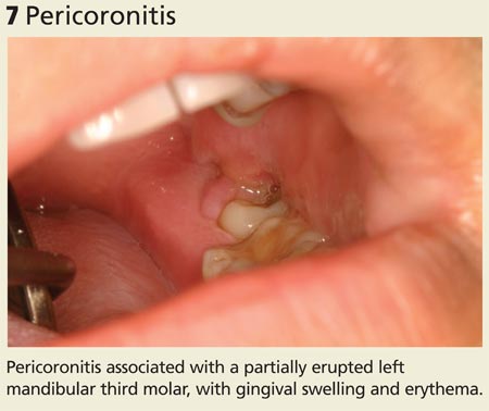 Pericoronitis image