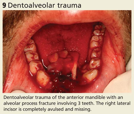 Dentoalveolar trauma image