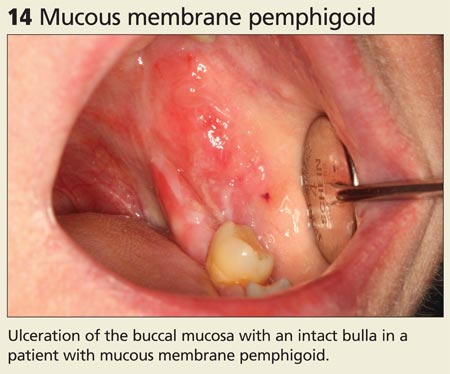 Mucous membrane pemphigoid image