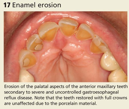 Enamel erosion image