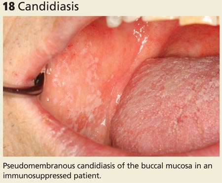 Candidiasis image