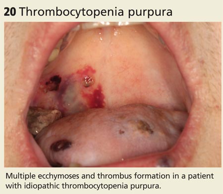 Thrombocytopenia purpura image