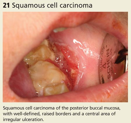 Squamous cell carcinoma image