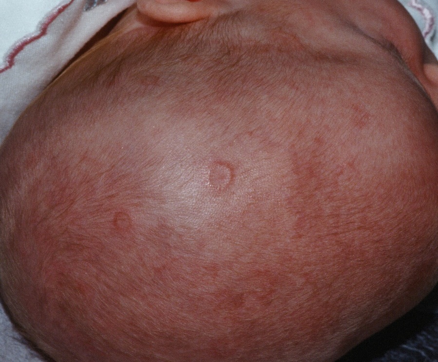 neonatal lupus erythematosus