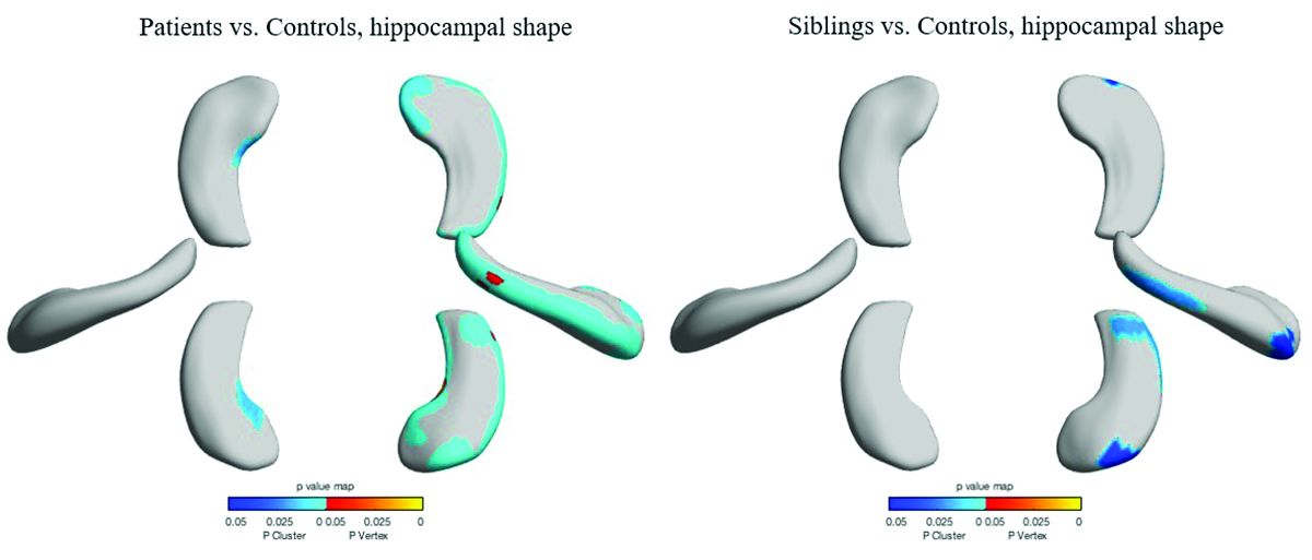 The hippocampi of patients with TLE and their nonaffected siblings show similar morphology and reductions in volume.