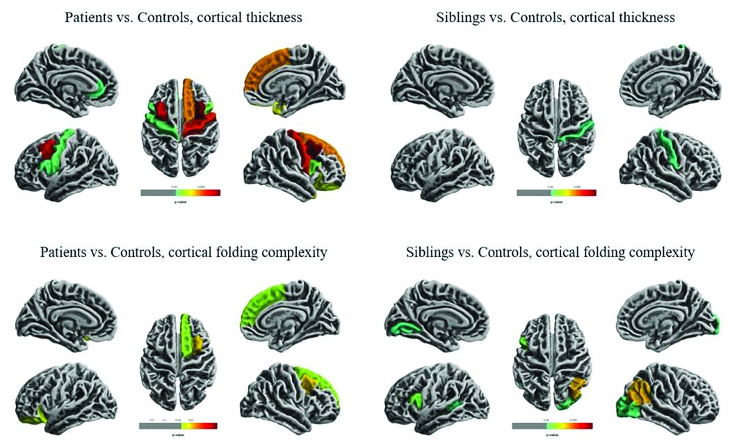 Patients with TLE and their unaffected siblings show similarities in cortical thinning and folding.