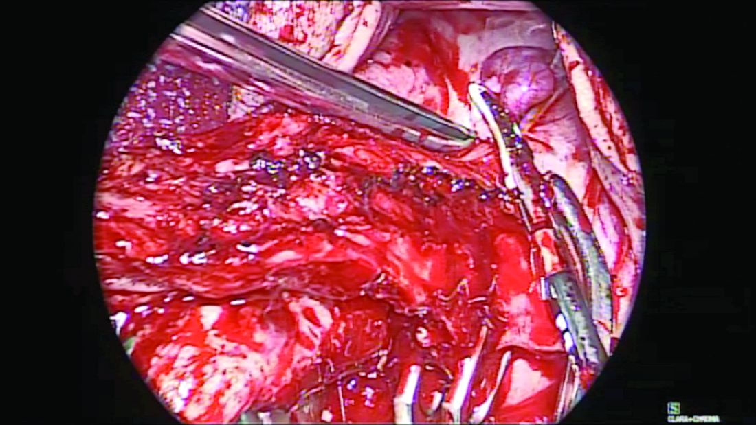 Salpingectomy is accomplished by sealing and dividing the mesosalpinx, after the round ligament is transected