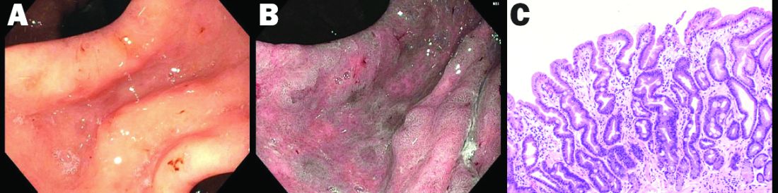 Figure 2. A. High definition white light endoscopy of patient with diffuse gastric intestinal metaplasia. B. NBI image of patient with diffuse GIM shows ridge and villous appearance. C. High powered H&amp;E of biopsy shows intestinal metaplasia.