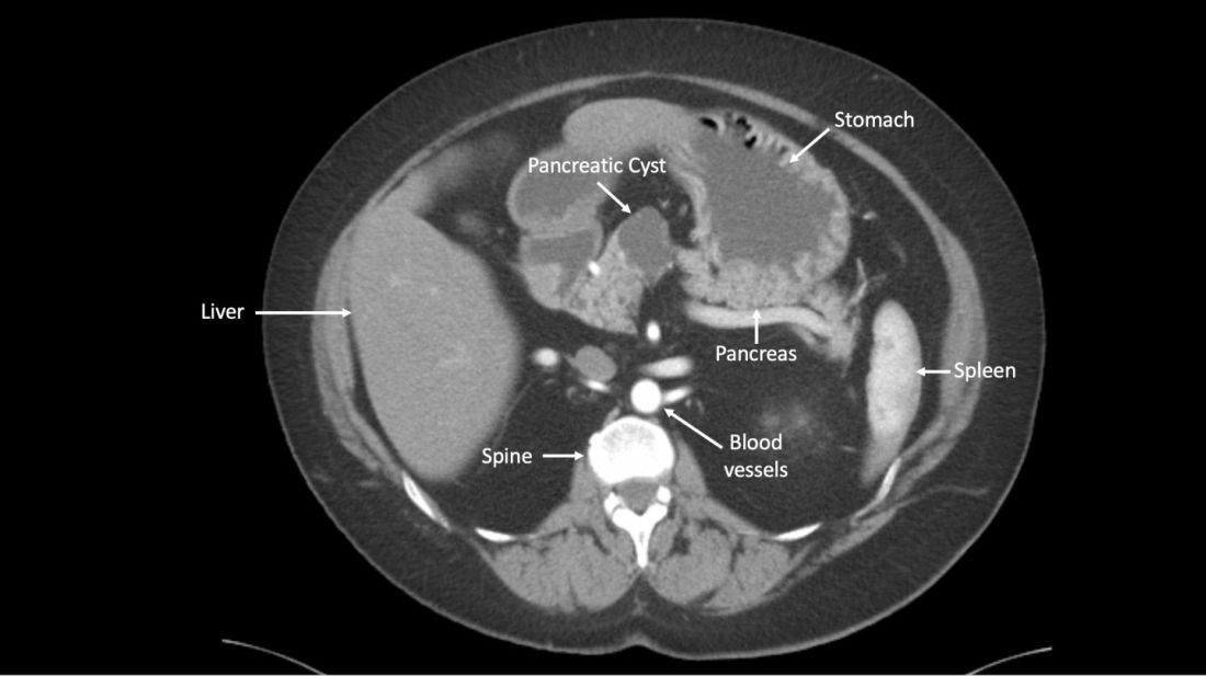 Johns hopkins pancreatic cancer