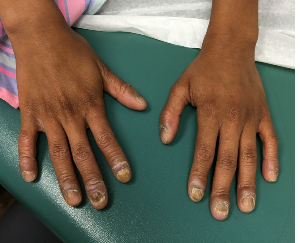 Nail dystrophy of 10 fingernails with hyperpigmented plaques on the cuticle and periungual skin