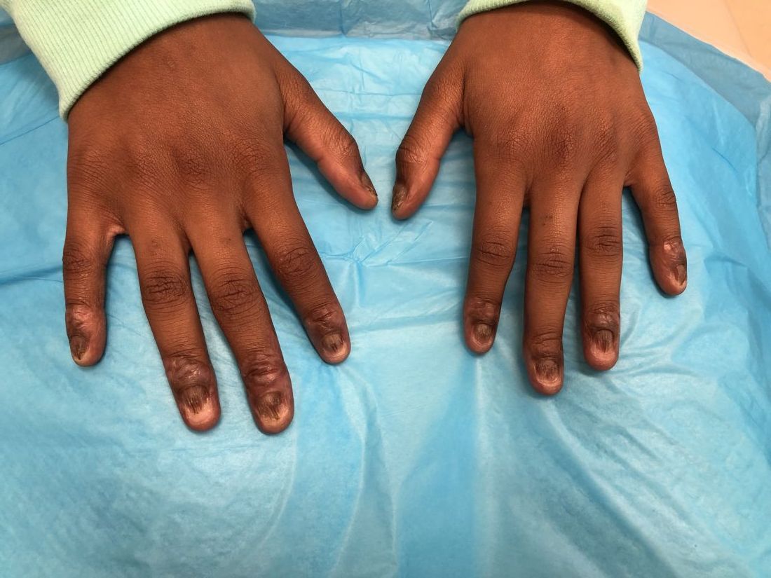 Nail dystrophy and nail plate thinning | MDedge Pediatrics