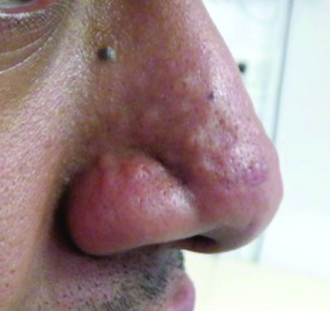 pimple on nose