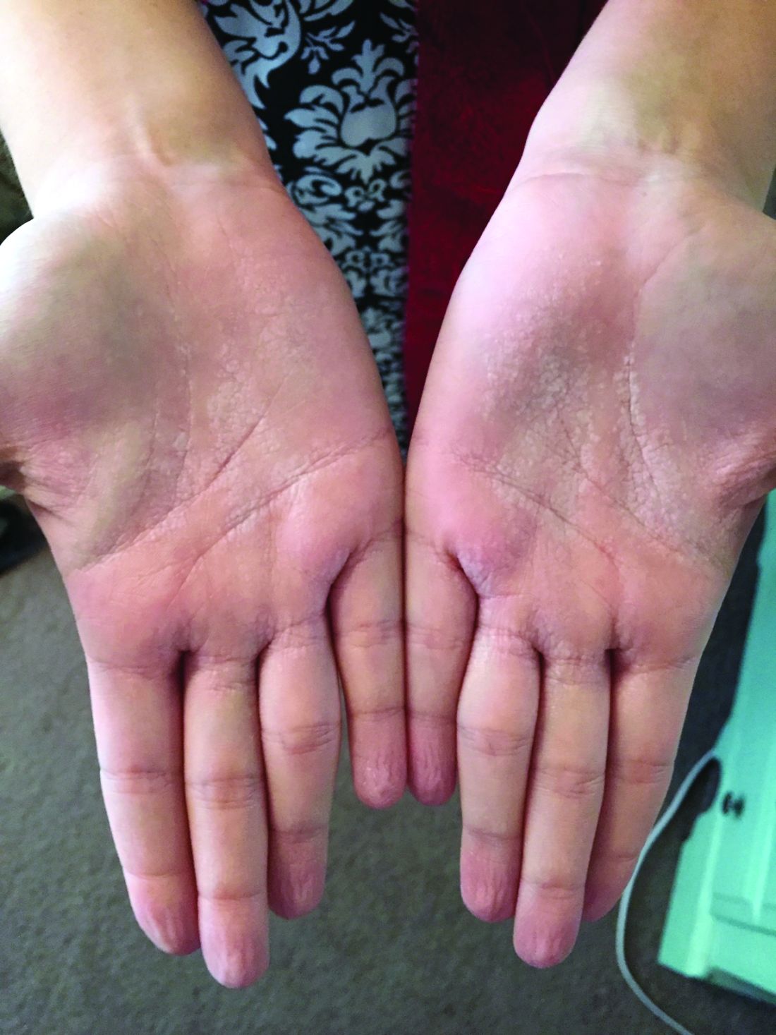 A woman with an asymptomatic eruption on her palms after exposure