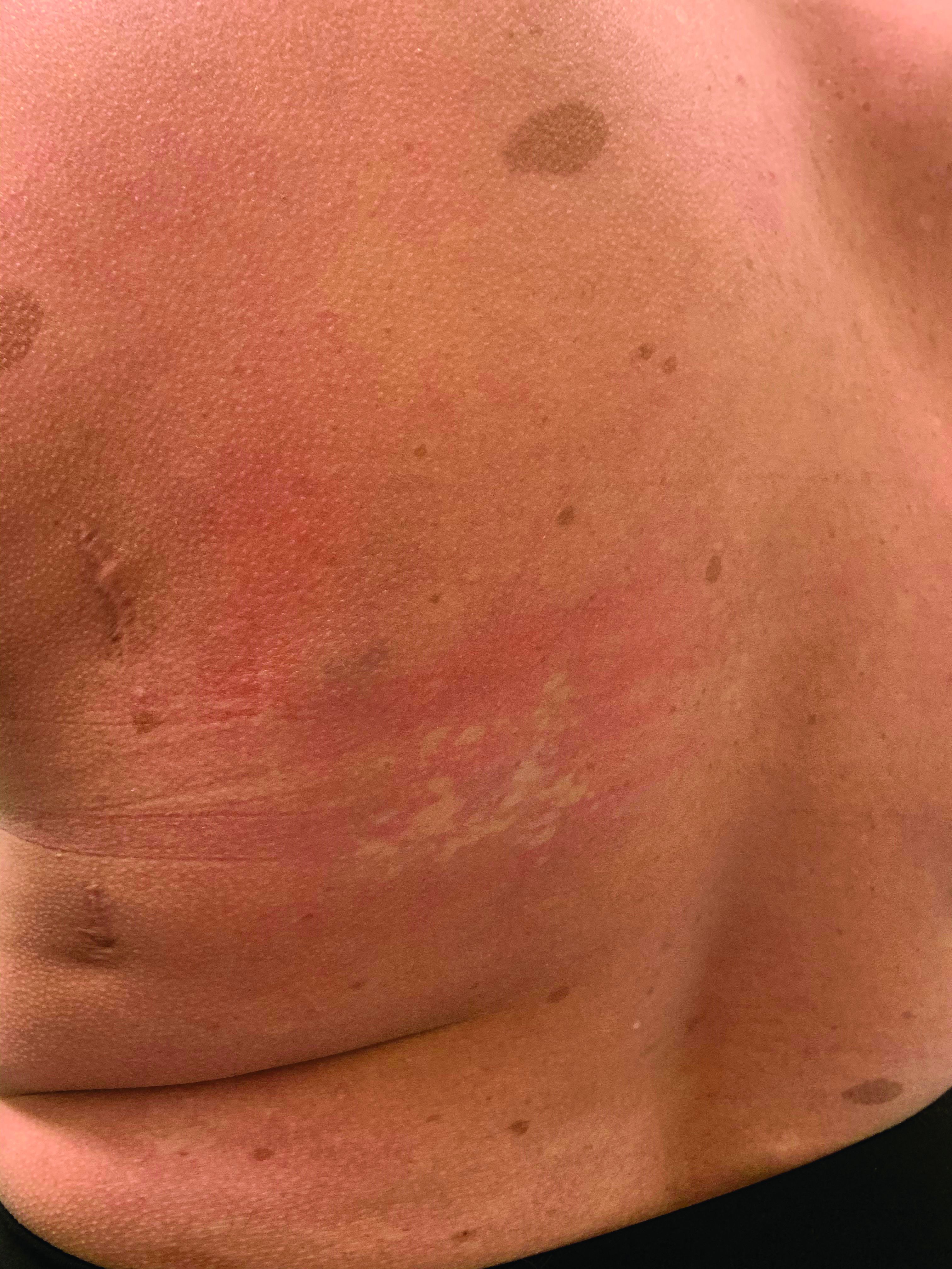 A girl presents with blotchy, slightly itchy spots on her chest, back