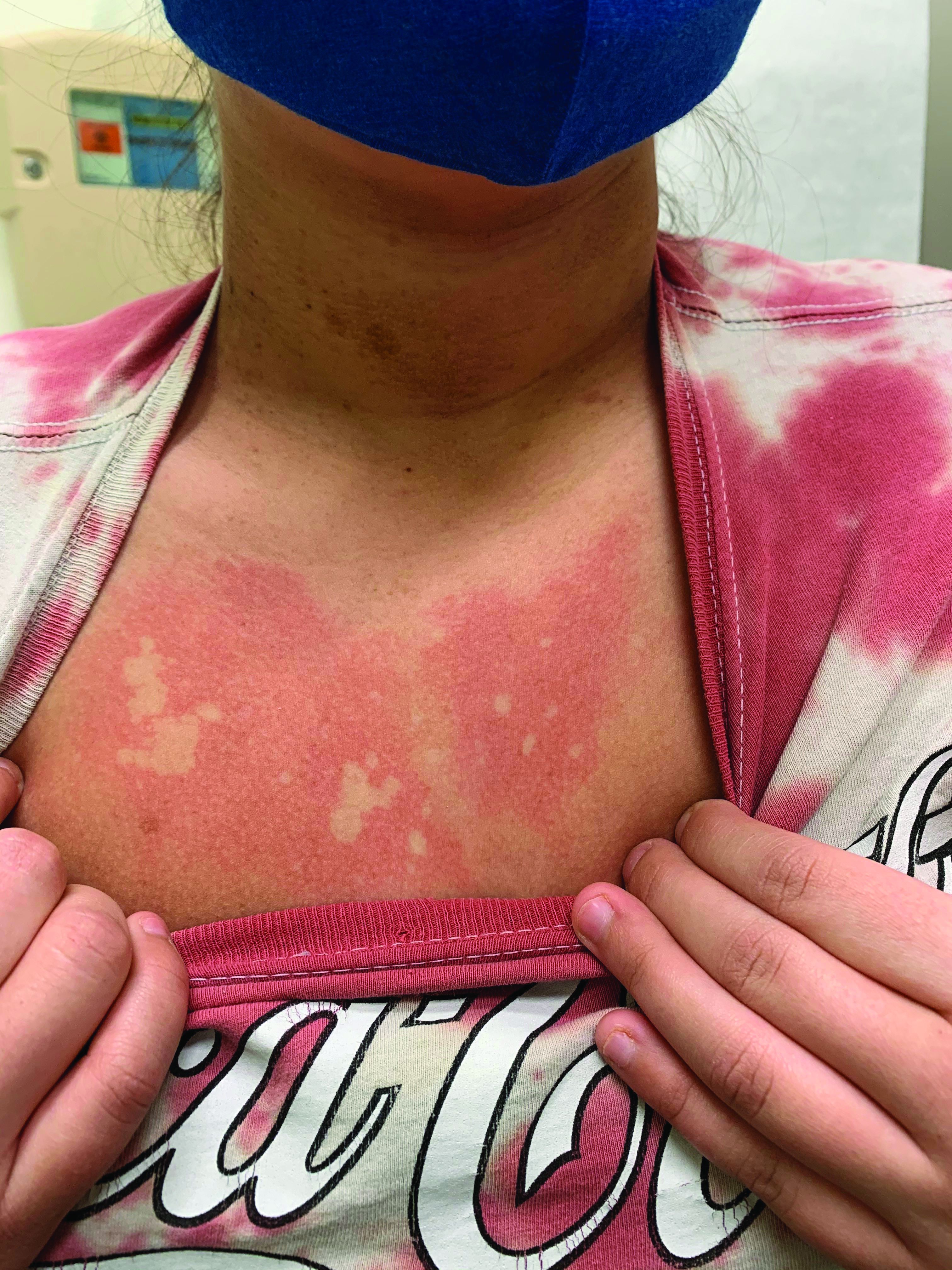 A girl presents with blotchy, slightly itchy spots on her chest, back