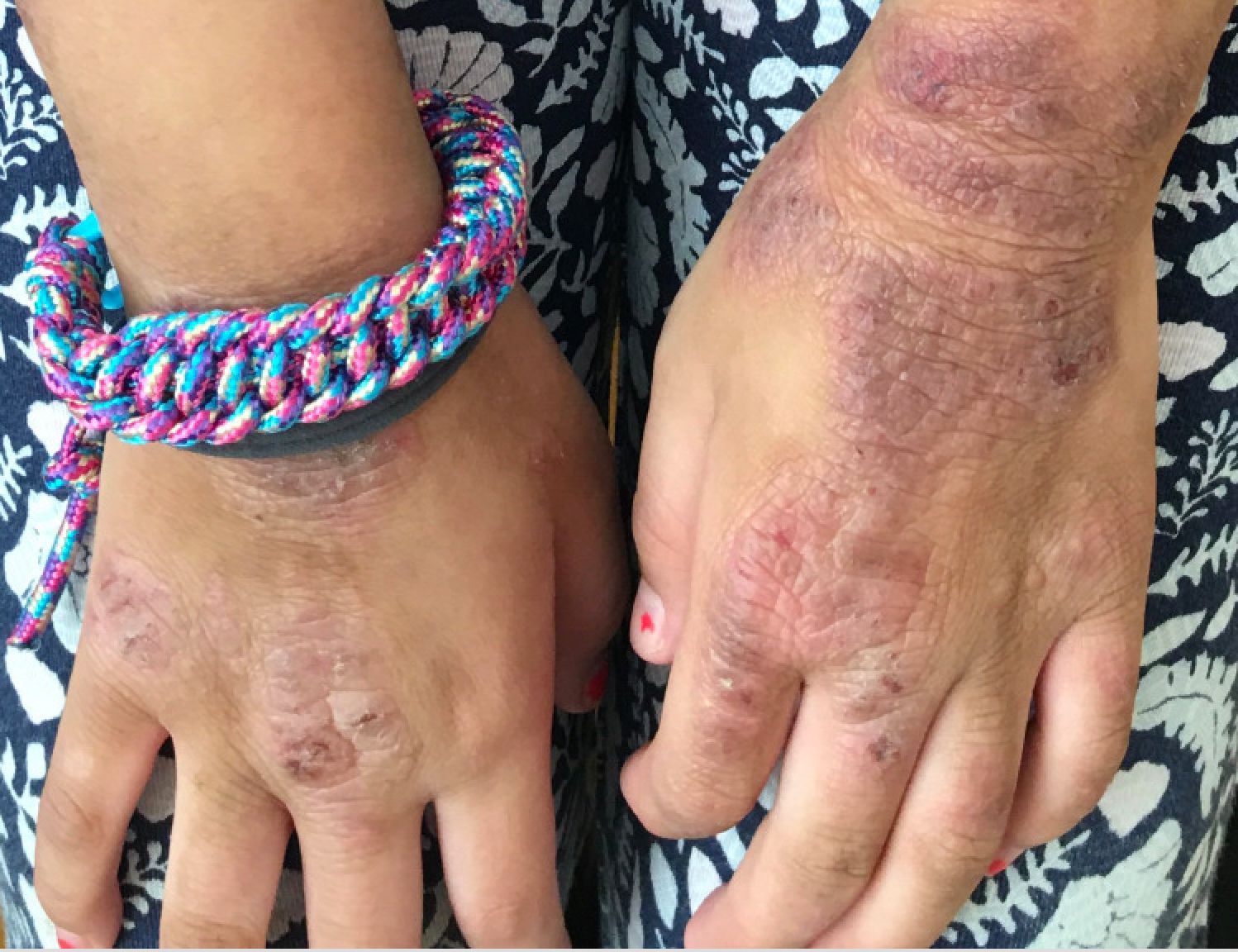 Hyperkeratotic plaques and fi ssures on the palms