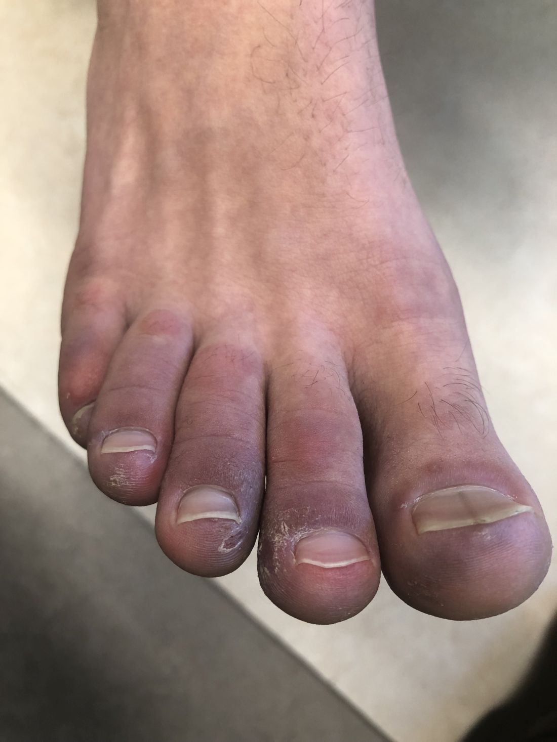 A 12-year-old male has persistent purple toes and new red lesions on his  hands | MDedge Pediatrics