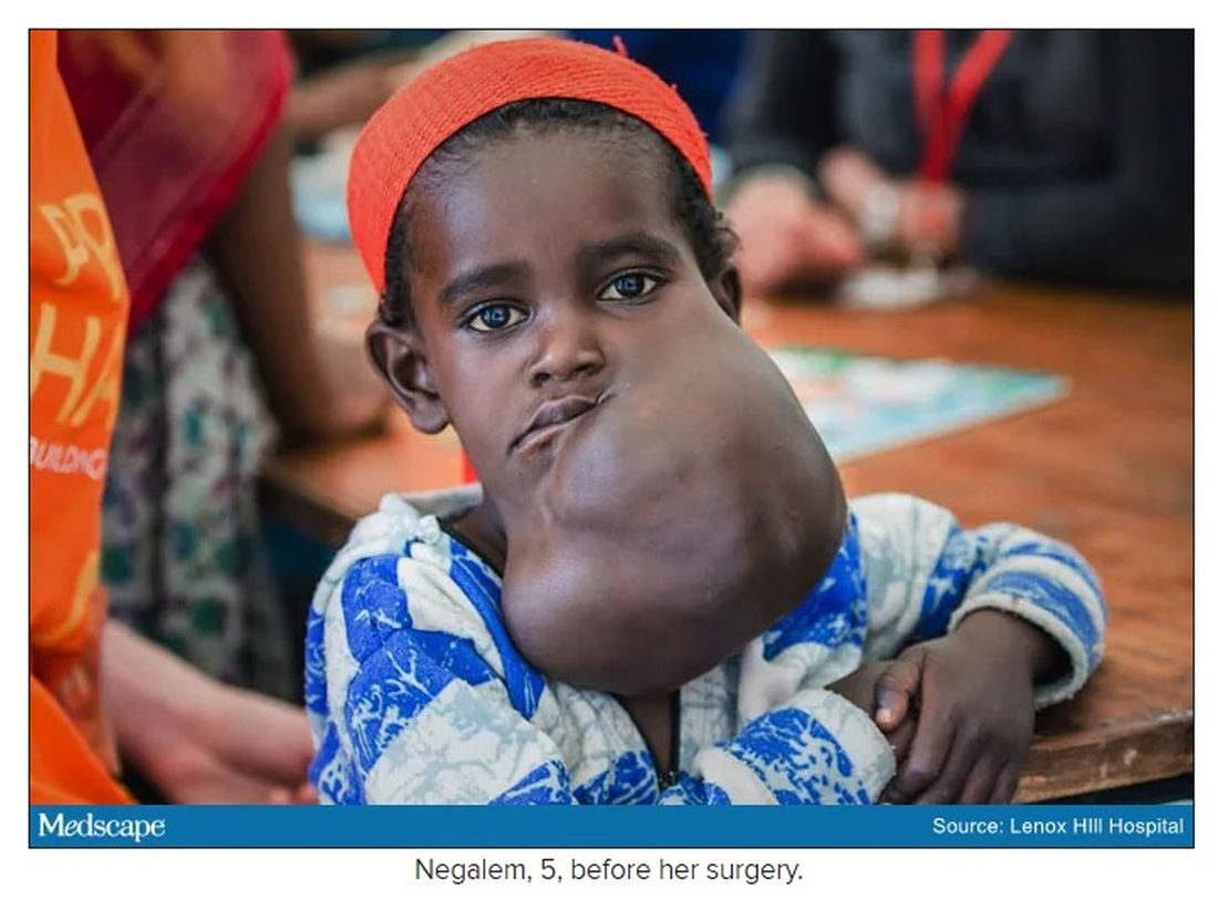 Negalem, 5, before her surgery