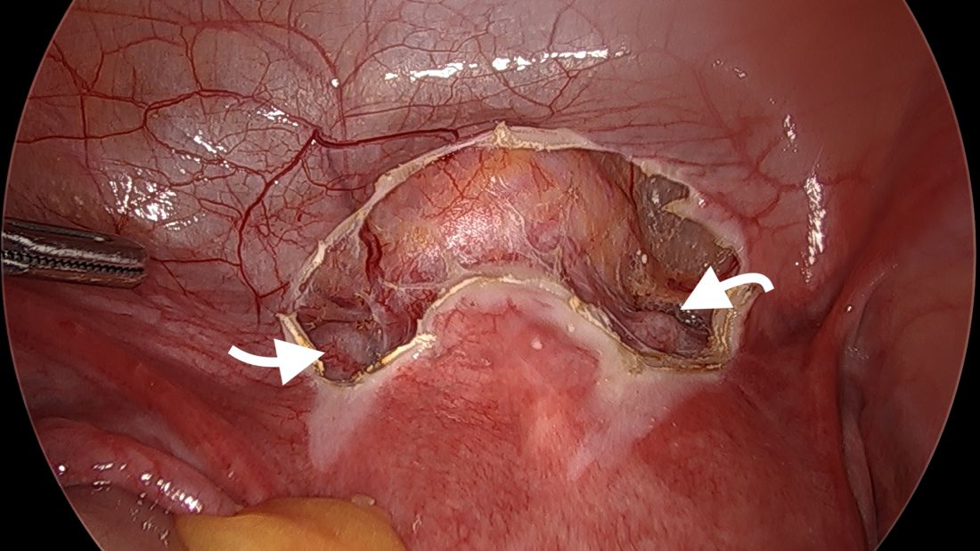 Fig 1. Dissection of the vesicouterine peritoneum. The uterine arteries are indicated by white arrows.