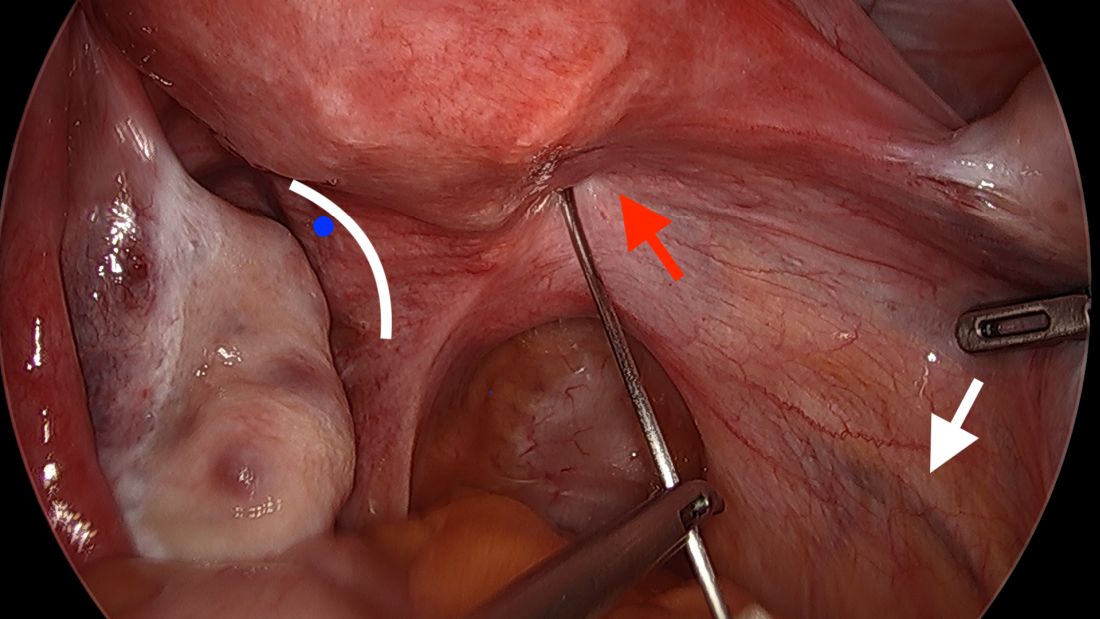 Fig 2. Initial placement of the first needle on the right. The uterine artery is indicated with a red arrow, the ureter with a white arrow, and the site of the insertion of the left needle is shown with a blue dot.