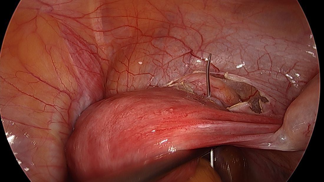 Fig 3. Twisting the uterus with the uterine manipulator enables the surgeon to better visualize the correct path of the needle placement.