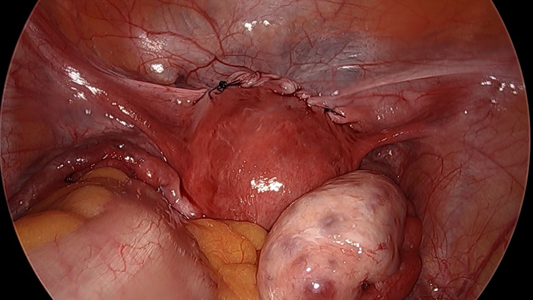 Fig 7. The vesicouterine peritoneum has been closed