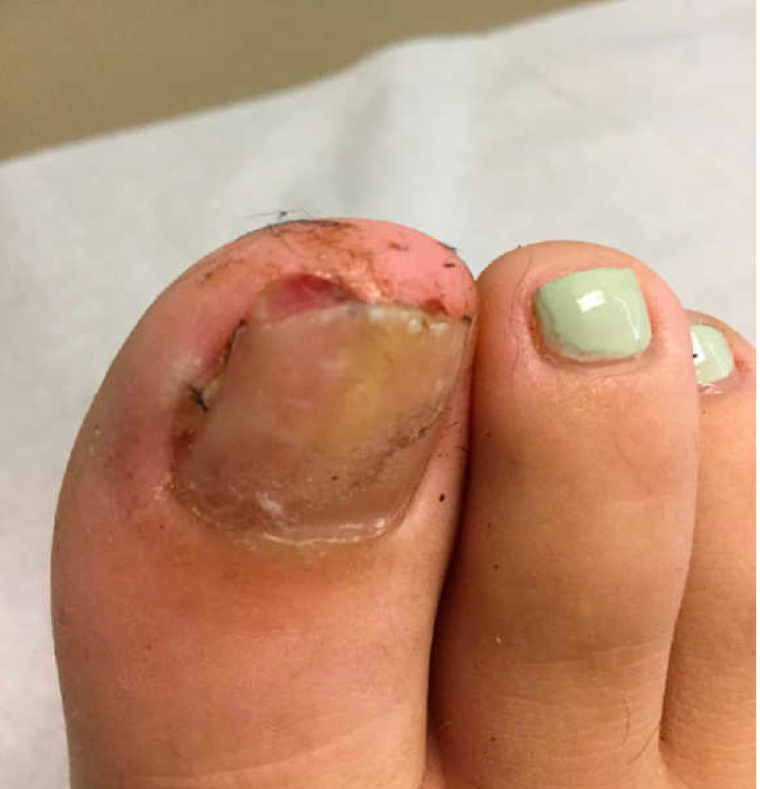 Surgical & Cosmetic Dermatology | Multiple glomus tumor in a patient with  neurofibromatosis type 1: a case report and literature review