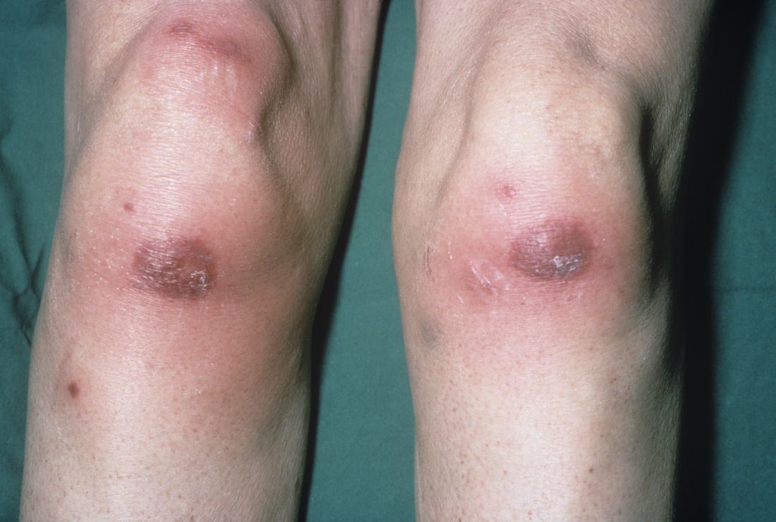 Close-up of discoloration on the knees (paraneoplastic phenomenon) in a patient with acute myeloid leukemia