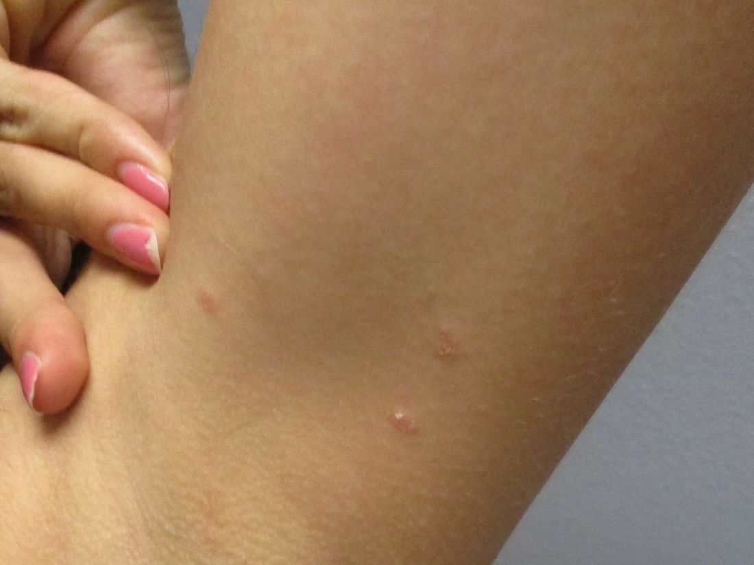 A 31-year-old female presented with a burning rash on upper arms