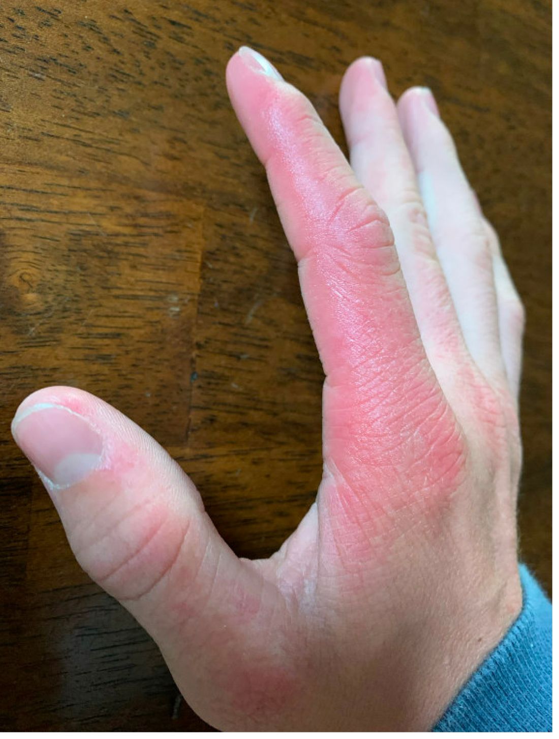 A 14-year-old male presents to clinic with a new-onset rash of the