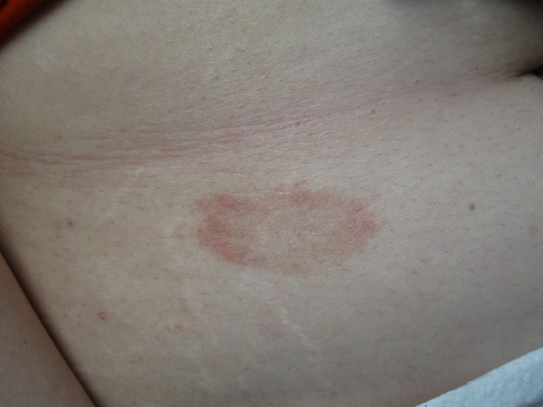 Woman with rash in groin