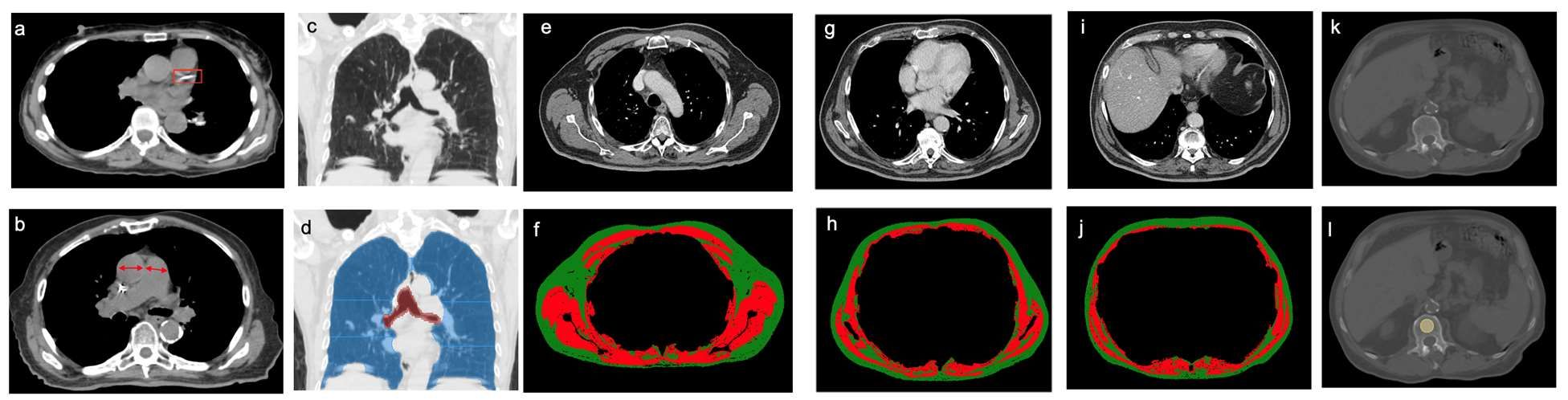 Quantitative analysis of CT images improved clinical stratification and predicted survival outcomes in the study.