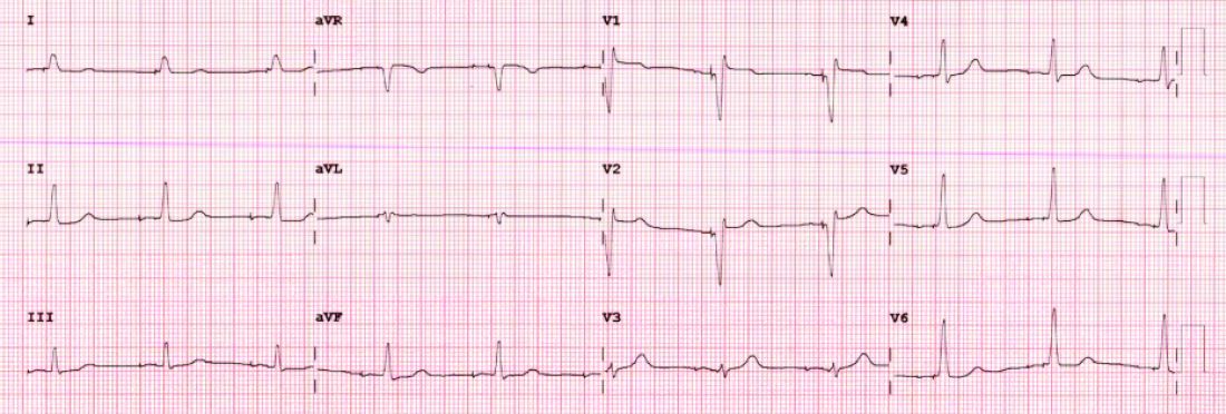 ECG after CSP showing right bundle-branch pattern in V1, rapid activation in V6, and narrow paced QRS complexes.