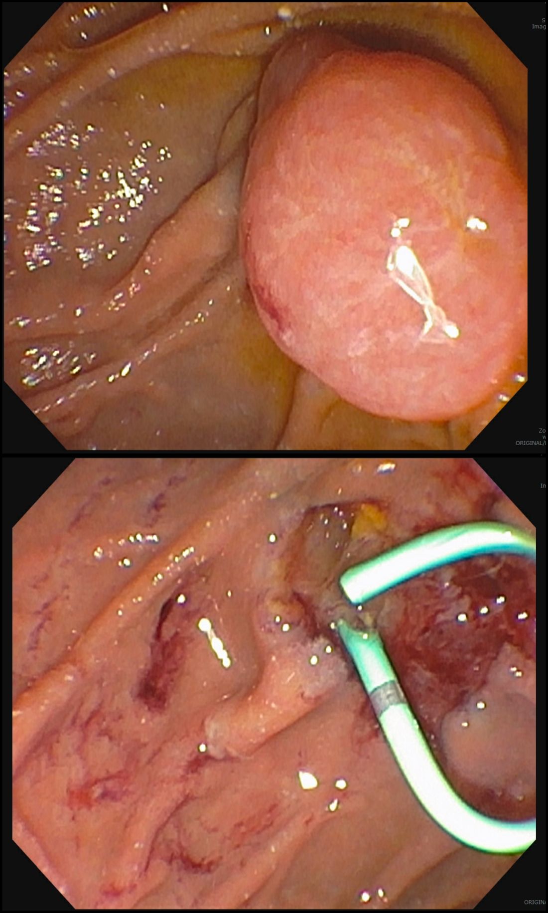 Figure 1: Duodenal adenomas before and after endoscopic mucosal resection (EMR).