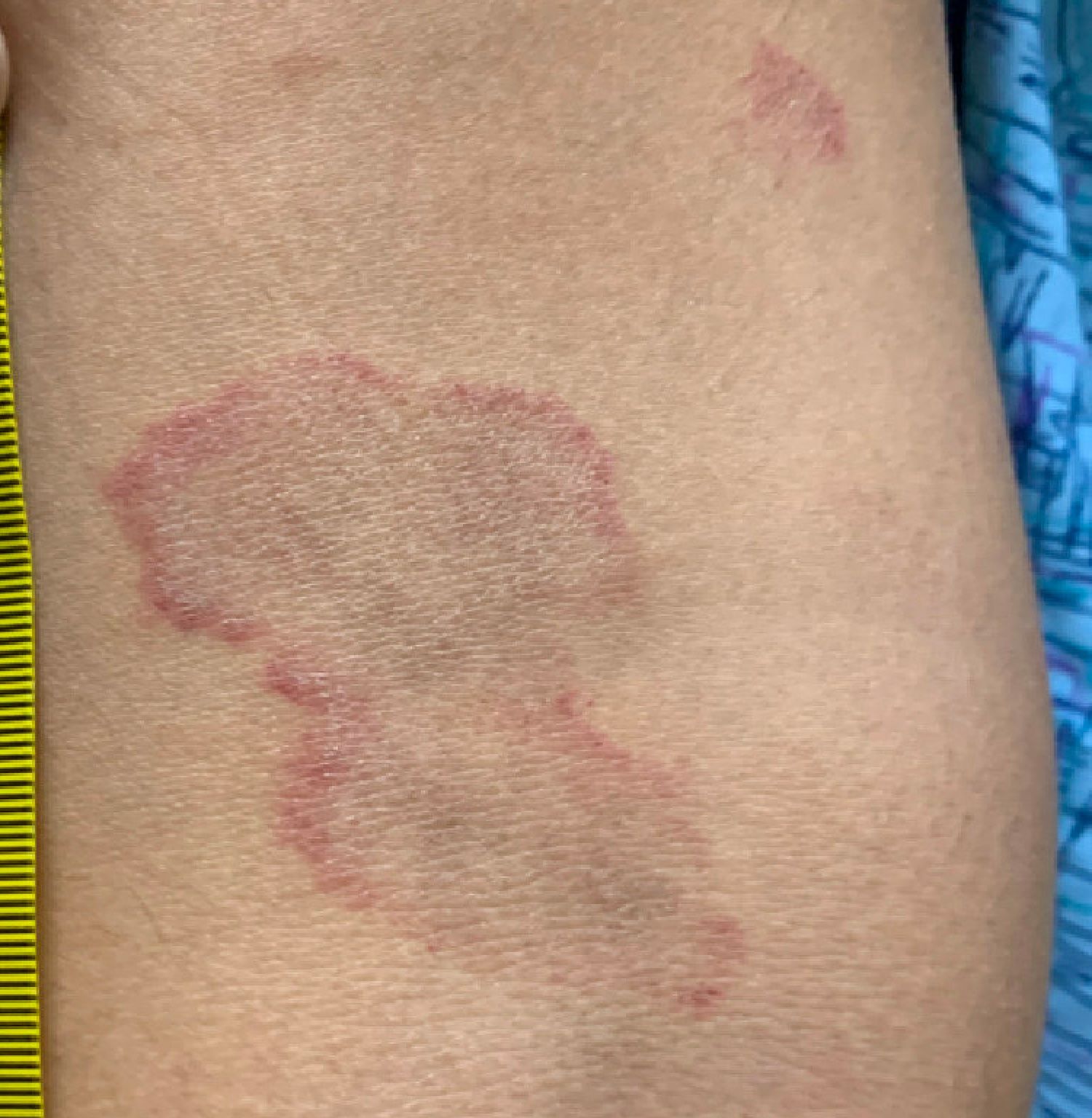 pinpoint rash on 9 year old abdomen