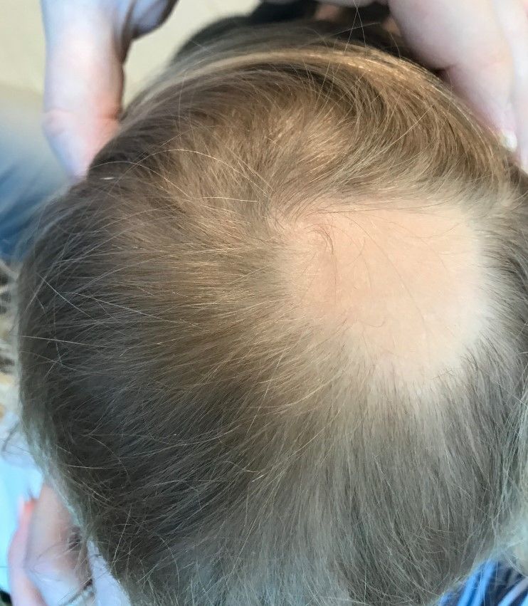 A toddler presents with patchy hair loss | MDedge Pediatrics