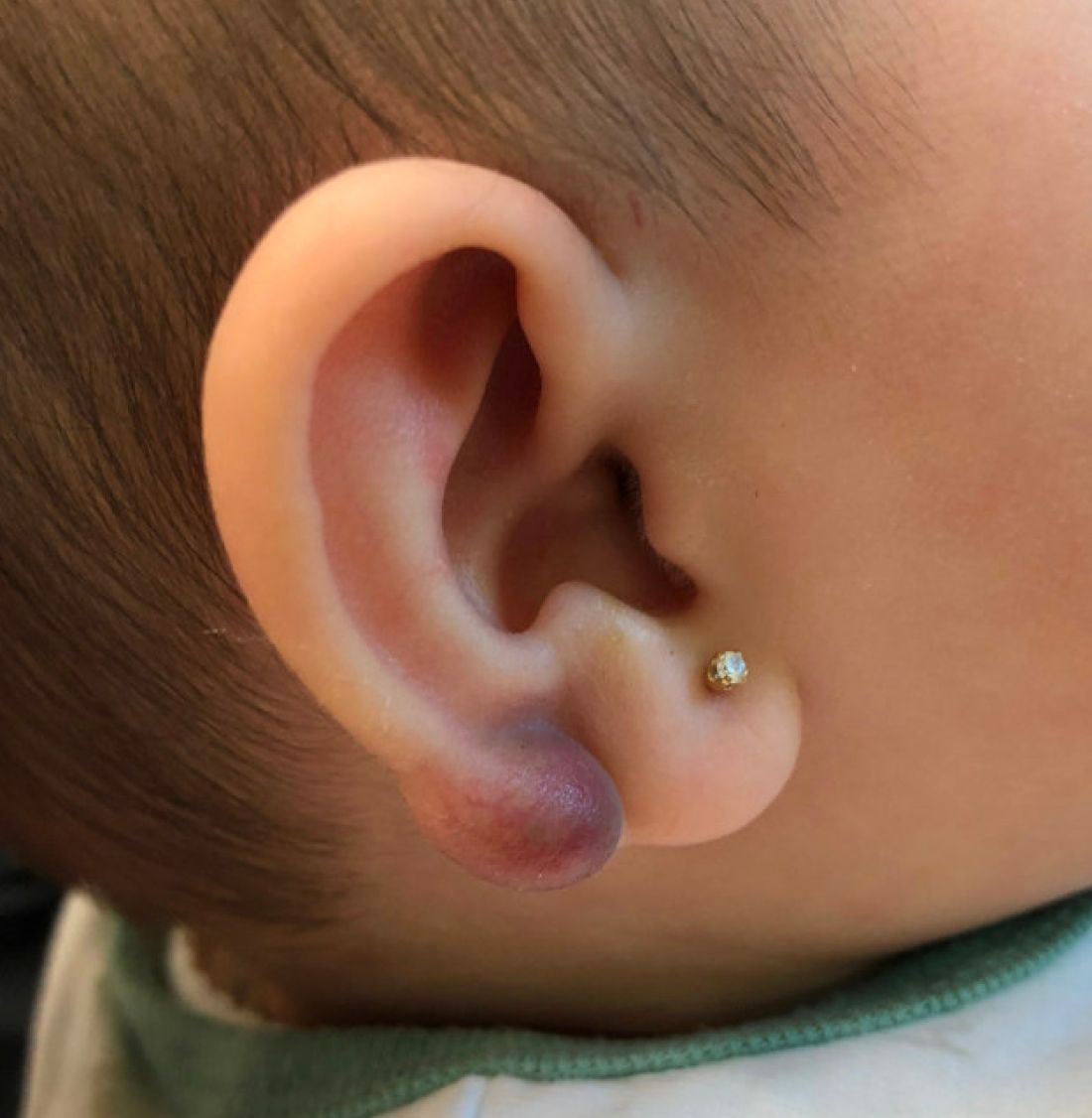 An infant with a tender bump on her ear  MDedge Pediatrics