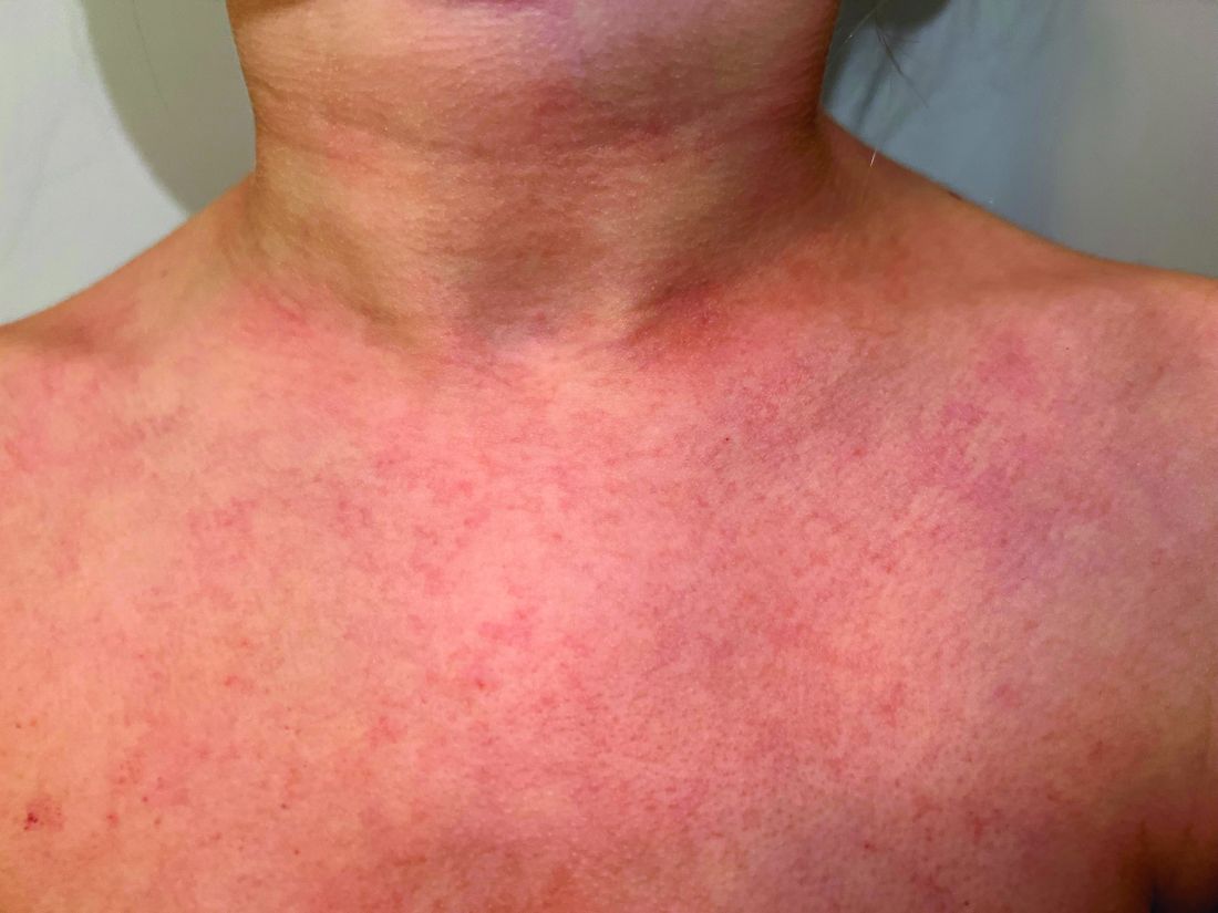 streptococcal pharyngitis rash