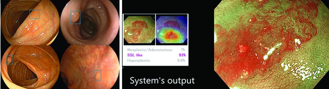 CADe colonic polyp detection on the left (source: Wision AI) and CADx real-time characterization of a colonic polyp on the right (Source: Y Mori and M Misawa)